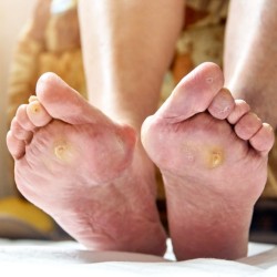 BUNION – What to know about this painful condition